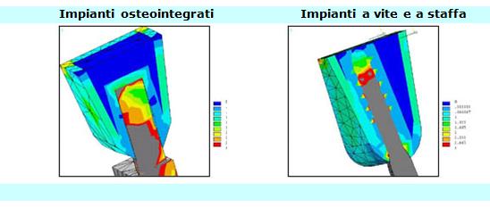 implantologia a carico immediato, impianti a vite, implantologia atraumatica, implantologia senza dolore