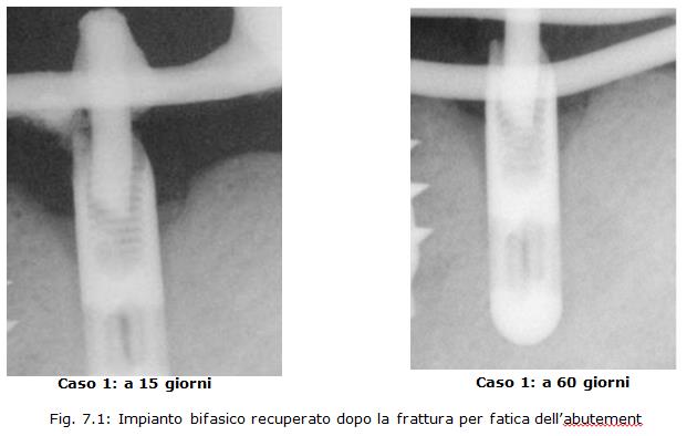 implantologia dentale, protesi ceramica, implantologia carico immediato, dentista