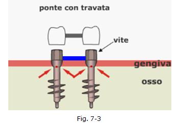 implantologia dentale, protesi ceramica, implantologia carico immediato, dentista