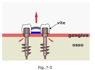 implantologia dentale, protesi ceramica, implantologia carico immediato, dentista