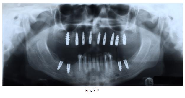 implantologia dentale, protesi ceramica, implantologia carico immediato, dentista