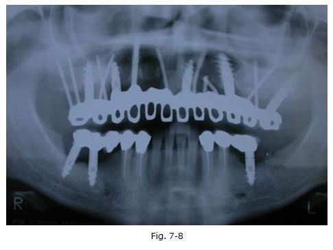 implantologia dentale, protesi ceramica, implantologia carico immediato, dentista