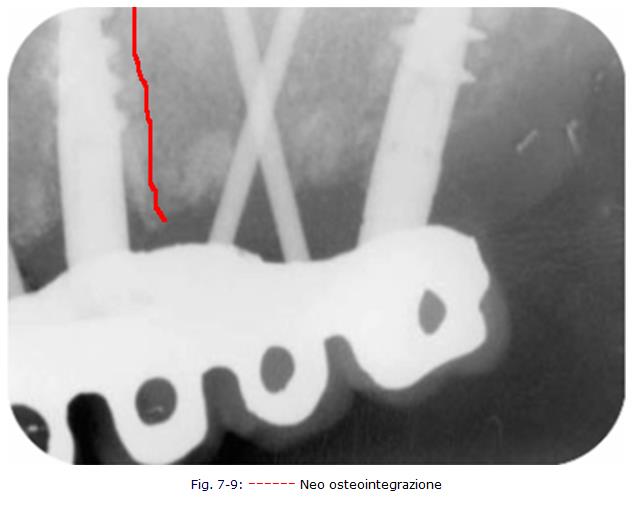 implantologia dentale, protesi ceramica, implantologia carico immediato, dentista