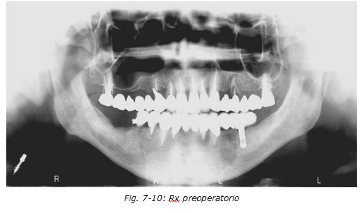 implantologia dentale, protesi ceramica, implantologia carico immediato, dentista