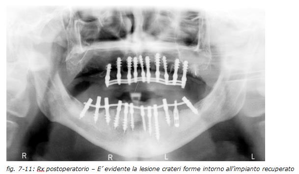 implantologia dentale, protesi ceramica, implantologia carico immediato, dentista