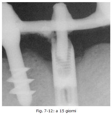 implantologia dentale, protesi ceramica, implantologia carico immediato, dentista