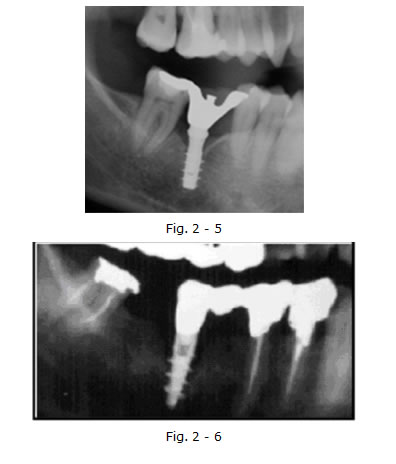 implantologia funzionale, dentista, dentiera, carie, impianti dentali, protesi fissa, protesi dentale, impianti a vite, ortodonzia, intarsi in ceramica