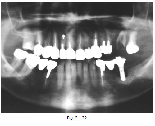 implantologia funzionale, dentista, dentiera, carie, impianti dentali, protesi fissa, protesi dentale, impianti a vite, ortodonzia, intarsi in ceramica