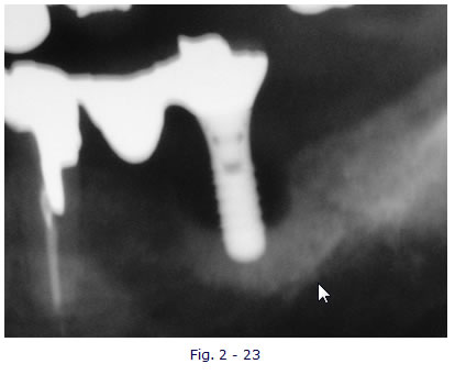 implantologia funzionale, dentista, dentiera, carie, impianti dentali, protesi fissa, protesi dentale, impianti a vite, ortodonzia, intarsi in ceramica