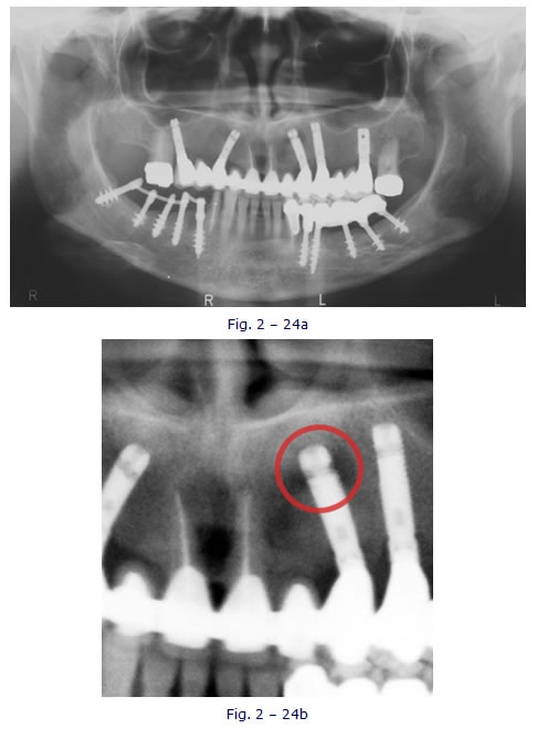 implantologia funzionale, dentista, dentiera, carie, impianti dentali, protesi fissa, protesi dentale, impianti a vite, ortodonzia, intarsi in ceramica