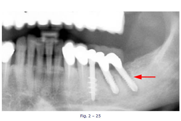 implantologia funzionale, dentista, dentiera, carie, impianti dentali, protesi fissa, protesi dentale, impianti a vite, ortodonzia, intarsi in ceramica