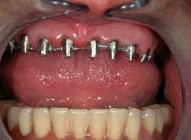 implantologia-elettrosaldata-titanio-protesi-dentale-estetica-fissazione-dentiere