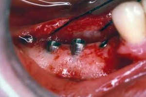 implantologia-elettrosaldata-titanio-protesi-dentale-estetica-fissazione-dentiere
