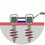 Fisiointegrazione negli impianti dentali | Centro Odontoiatrico Specializzato Brandizzo (TO)