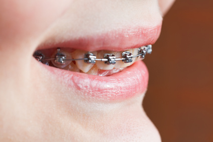 Ortodonzia apparecchi dentali bambini e invisibili Torino Brandizzo