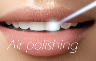 Igiene orale professionale e Air polishing