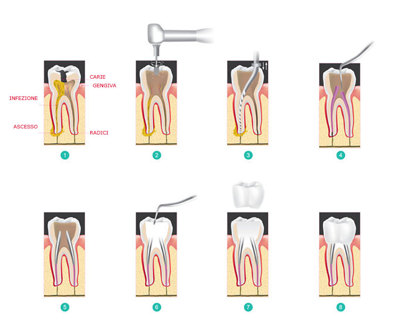 Endodonzia 