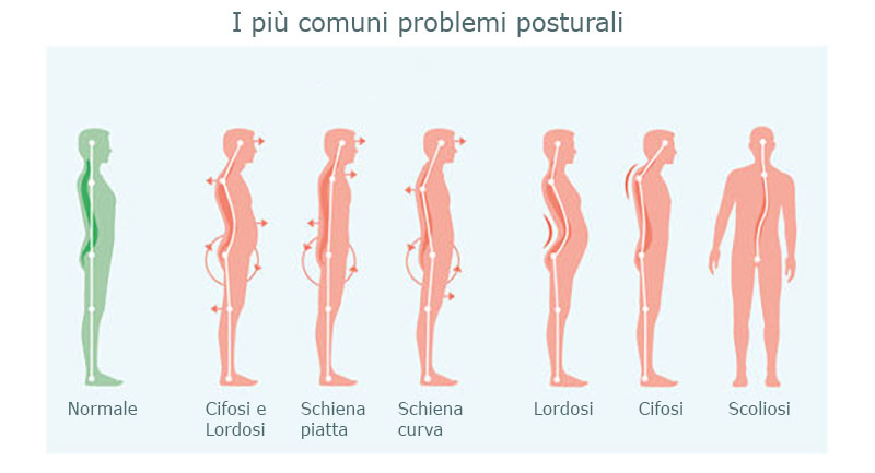 Principali problemi posturali