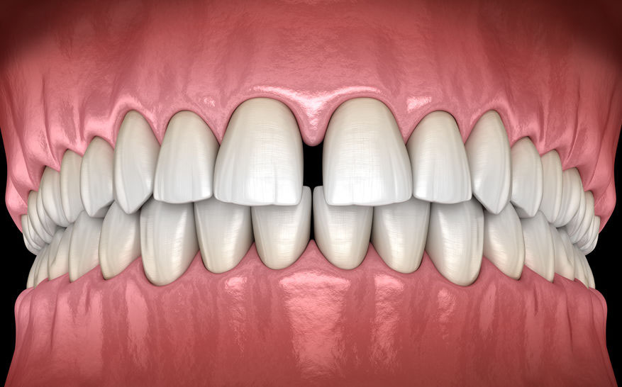 Diastema e aligner invisibili