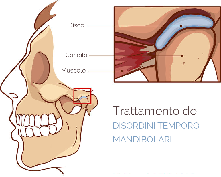 trattamento dei disturbi temporo mandibolari